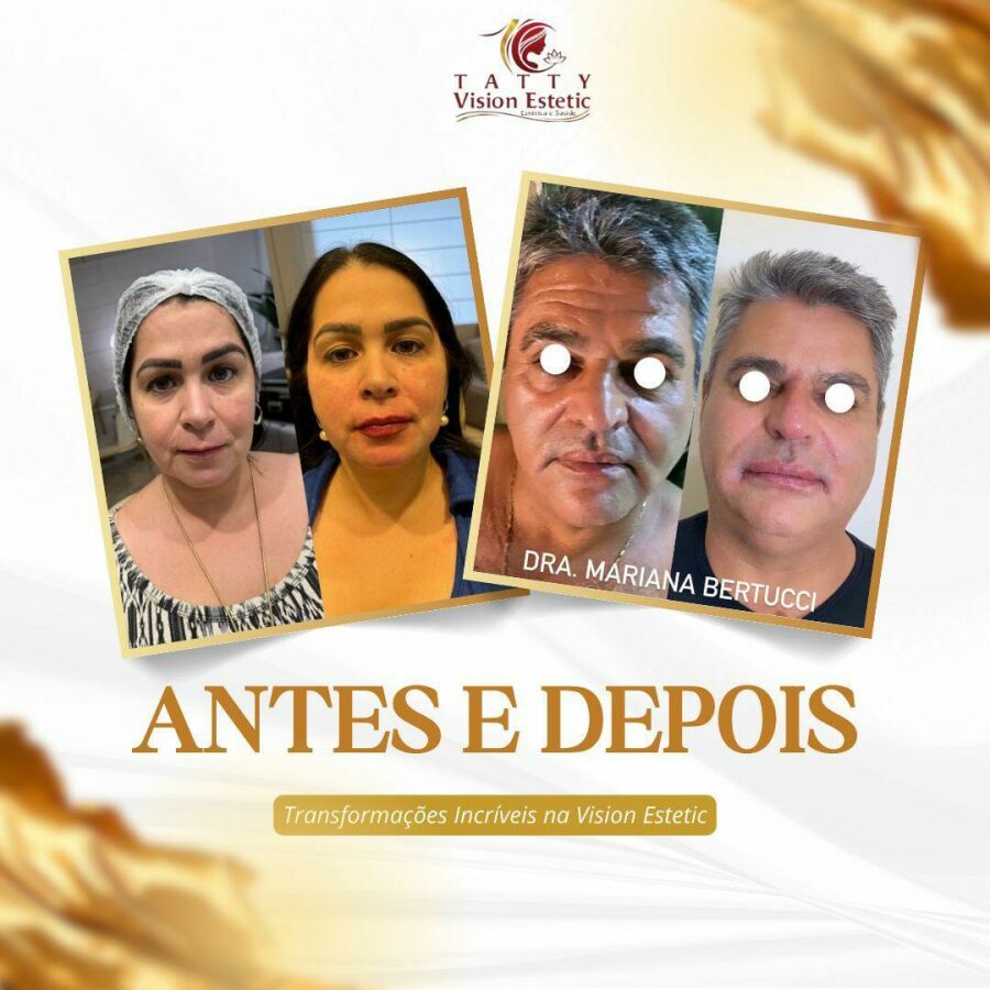 Imagem antes depois clina Tatty